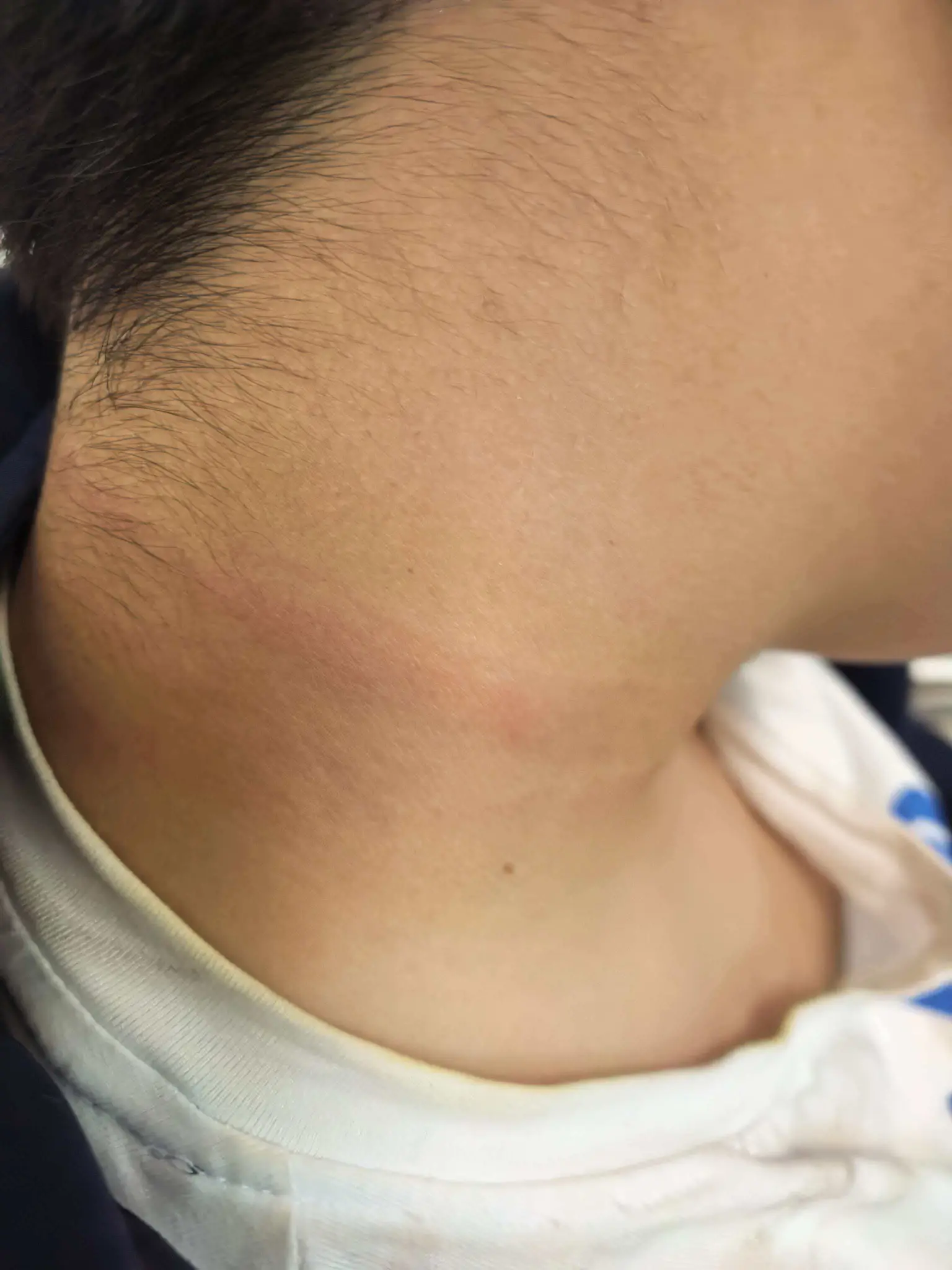 颈部伤情（一）